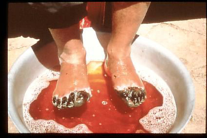 Kul's frostbitten feet (photo Urs Hefti)